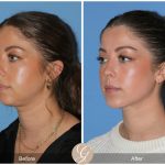 How to Achieve Facial Contouring in Young Individuals (Ages 18–30): Defining Jawline and Neck for Harmonious Features